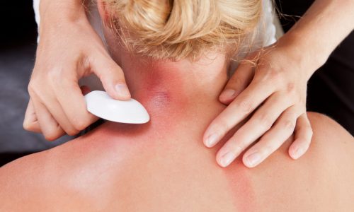 Above view of woman receiving gua-sha treatment on back and neck